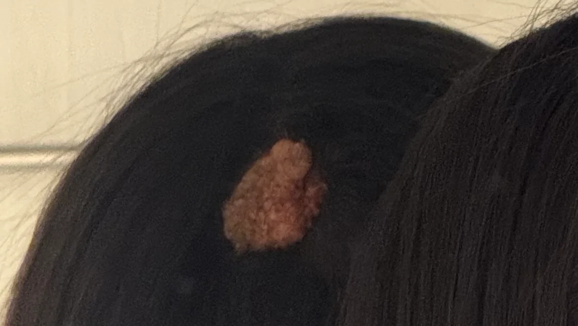 Funds to surgically remove my Nevus Sabaceous. – GoFundMe Fundraiser gofundme Donation Help